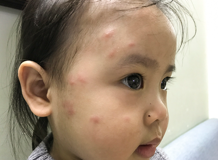 em bé bị muỗi đốt